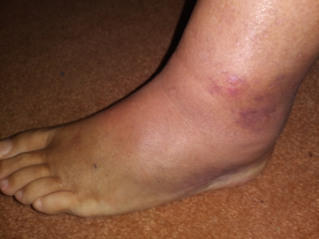 No description provided for: /2019/04-06/0514-injured-foot/photo01.html