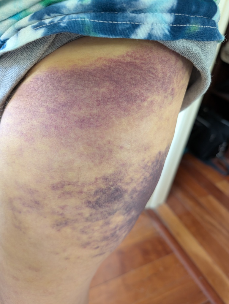 No description provided for: /2025/07-09/0730-thigh-bruise/photo01.html