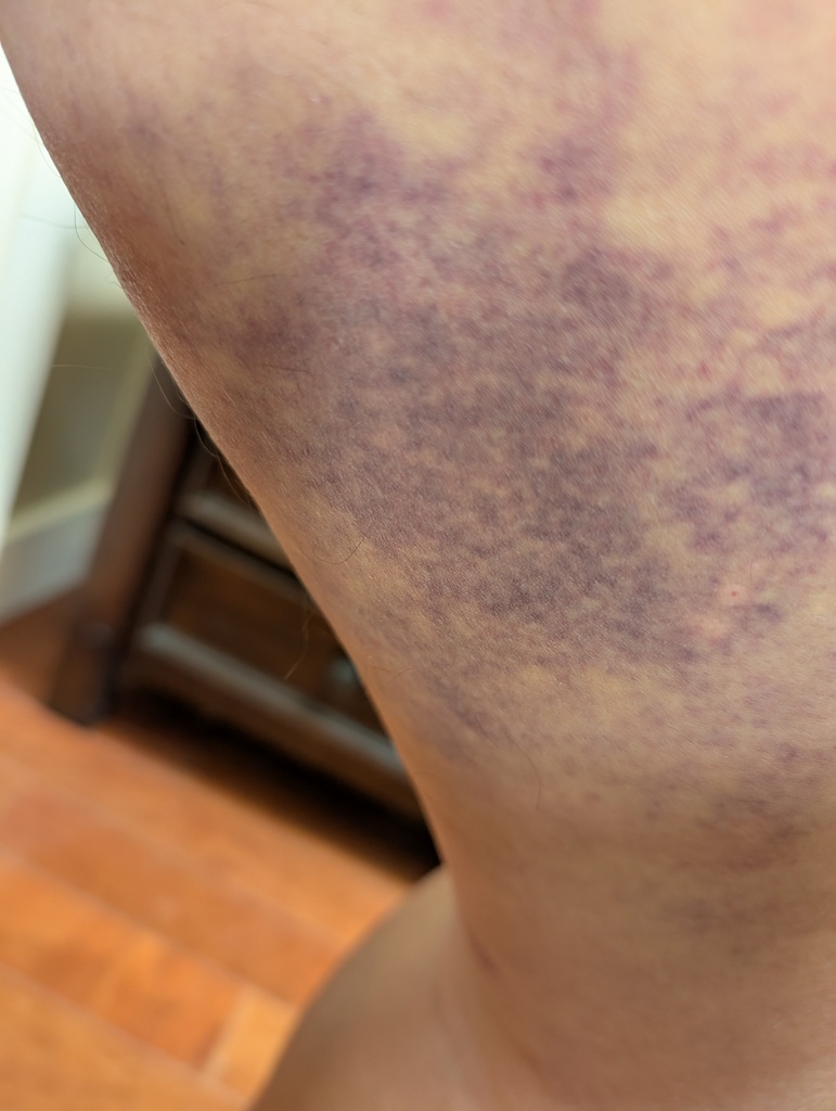 No description provided for: /2025/07-09/0730-thigh-bruise/photo02.html